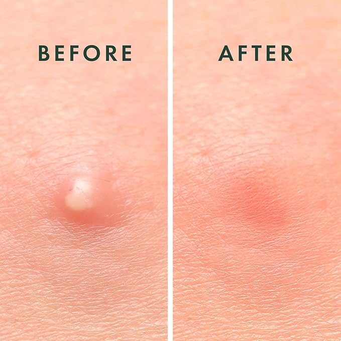 OverNight Pimple Patch