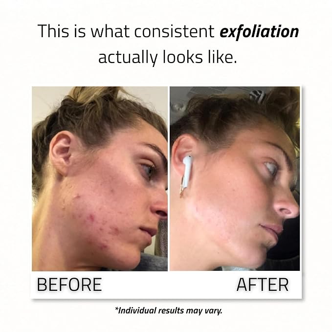 Glycolic 30% Peel 1oz