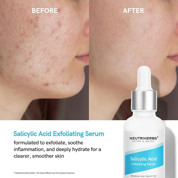 Salicylic Acid Serum - For Acne-prone Skin