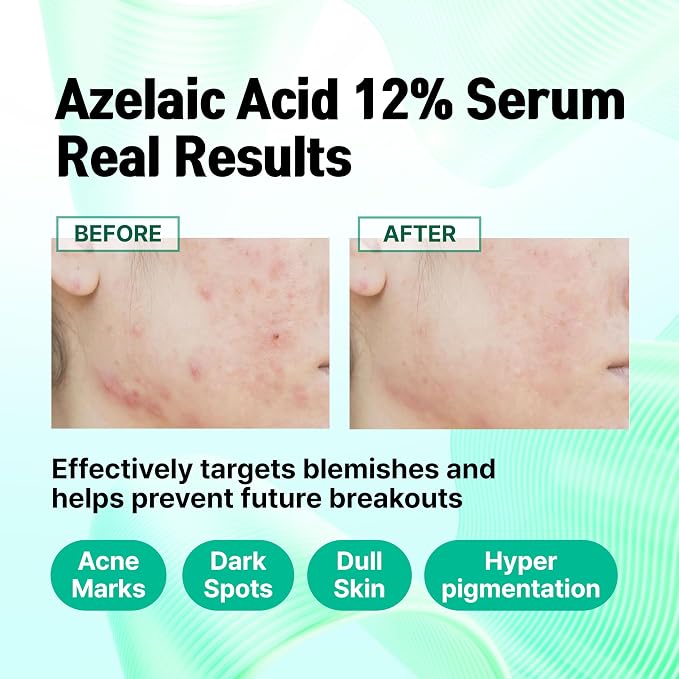 Azelaic Acid