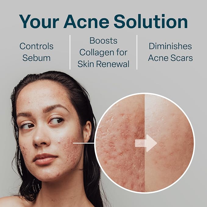 Acne Pads