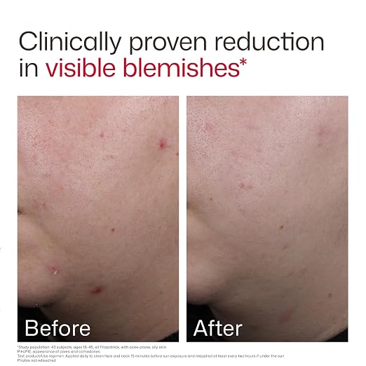 01 - New Blemish Prone (1.7 oz)