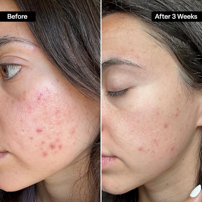 Acne Pads